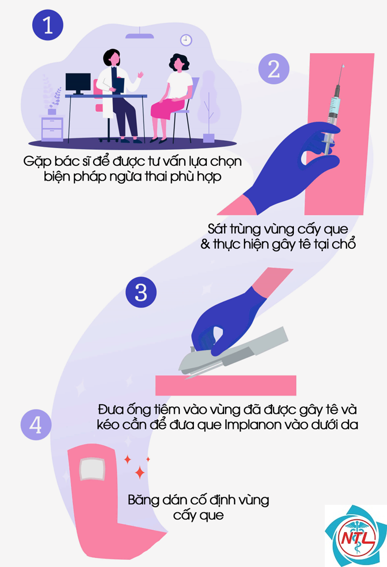 biện pháp cấy que - Image 5