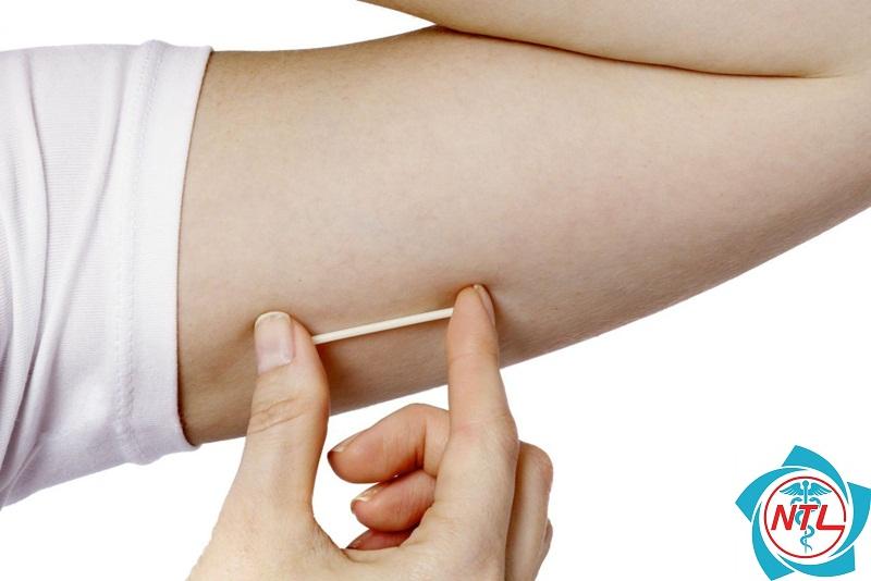 biện pháp cấy que