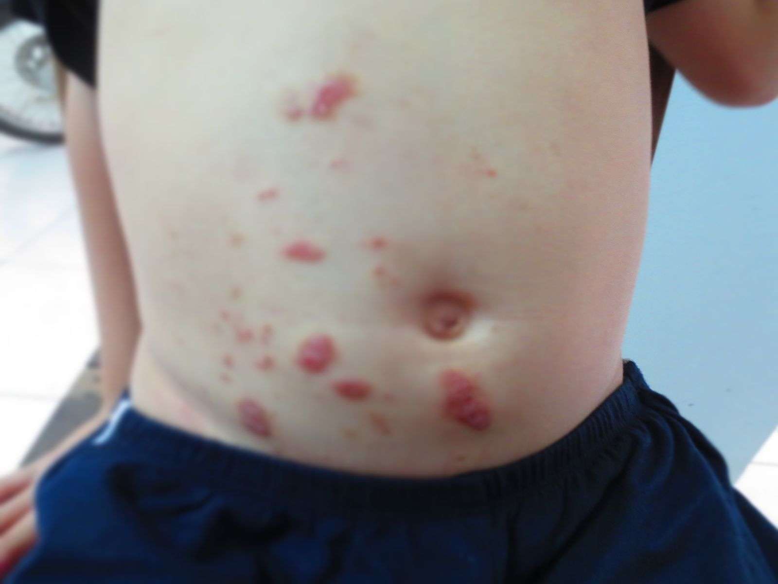 biểu hiện của trẻ bị nhiễm sán - Image 1