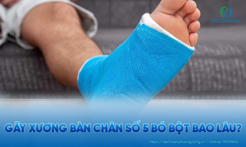 bó bột bàn chân - Image 3