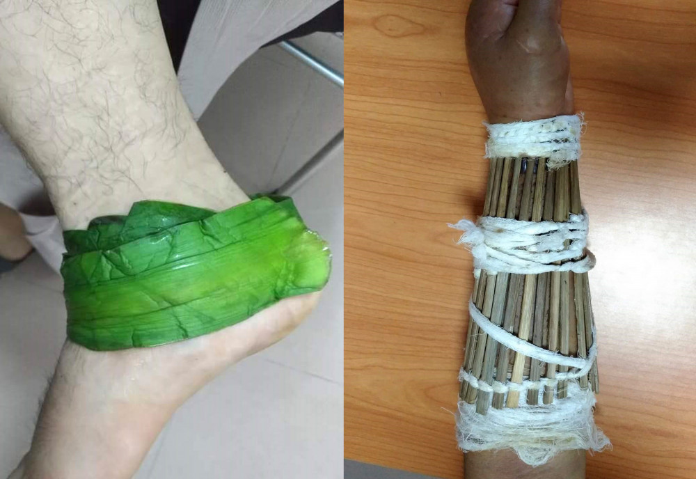 bó thuốc trị gãy xương - Image 2