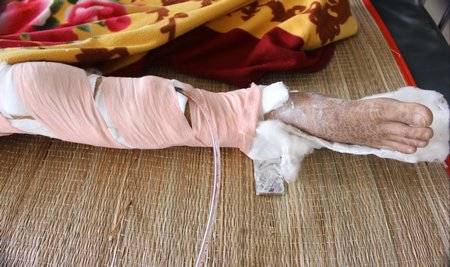 bó thuốc trị gãy xương - Image 5
