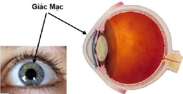bỏng giác mạc là gì - Image 3