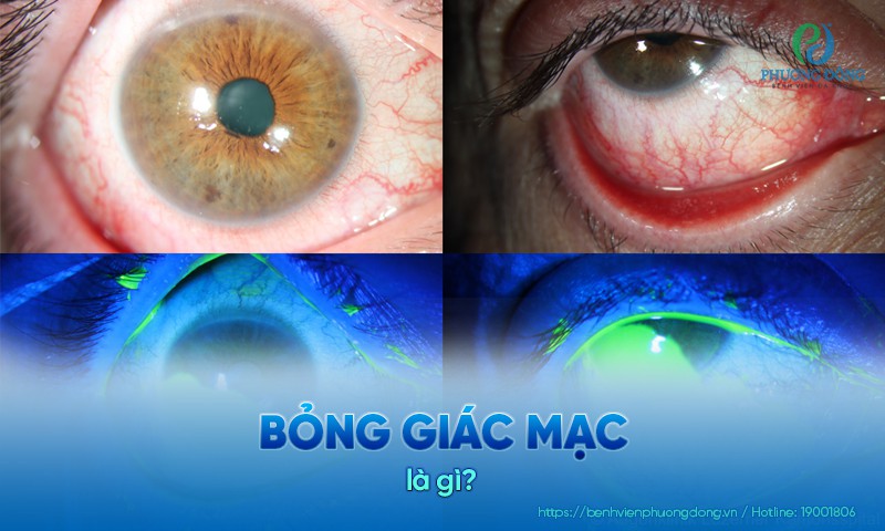 bỏng giác mạc là gì - Image 4