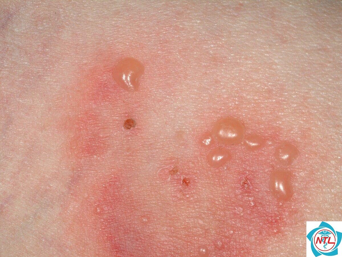 bóng nước tự phát trên da - Image 4