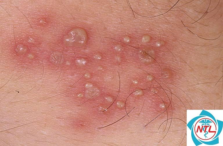 bóng nước tự phát trên da