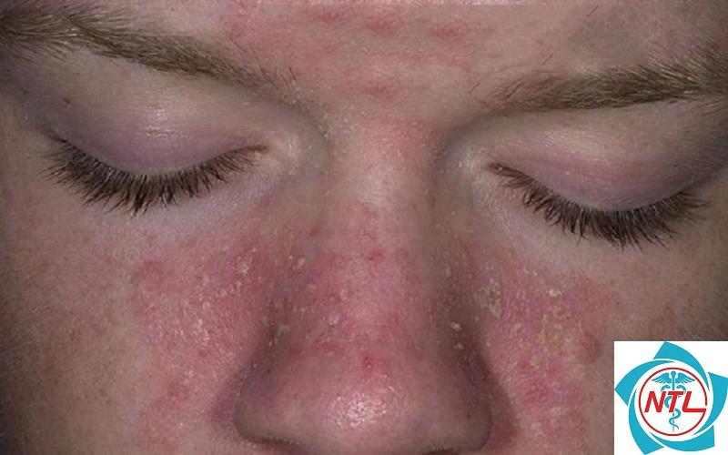 bong tróc da quanh mũi - Image 3