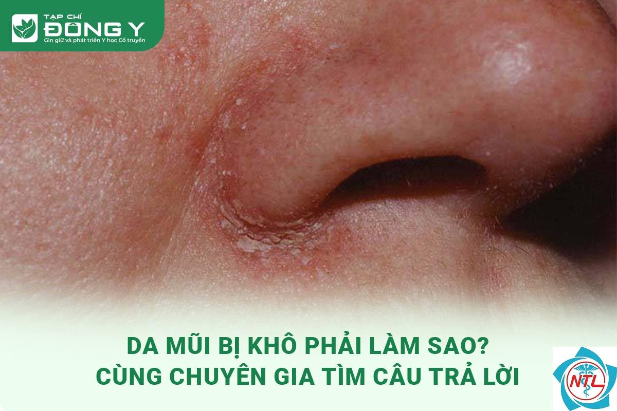 bong tróc da quanh mũi - Image 5