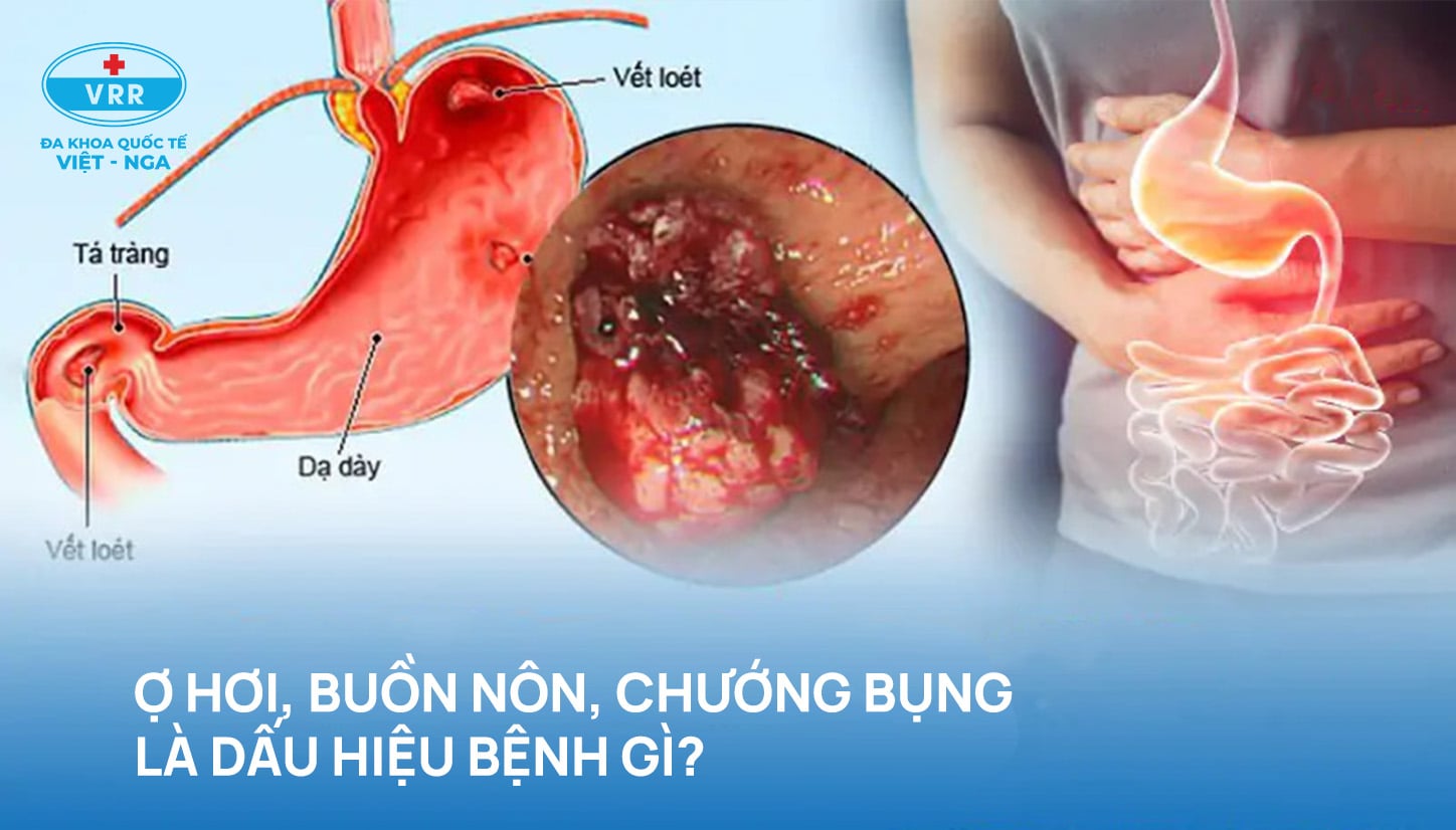 buồn nôn là dấu hiệu bệnh gì - Image 3