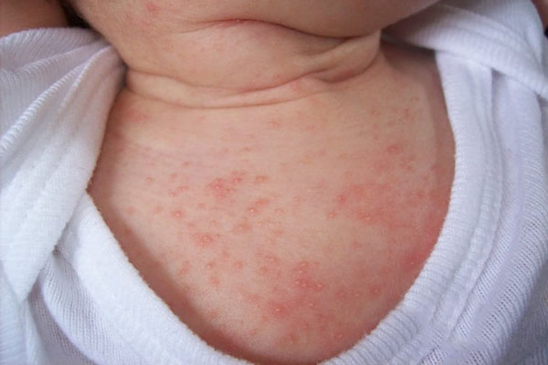 các bệnh da liễu ở trẻ sơ sinh - Image 4