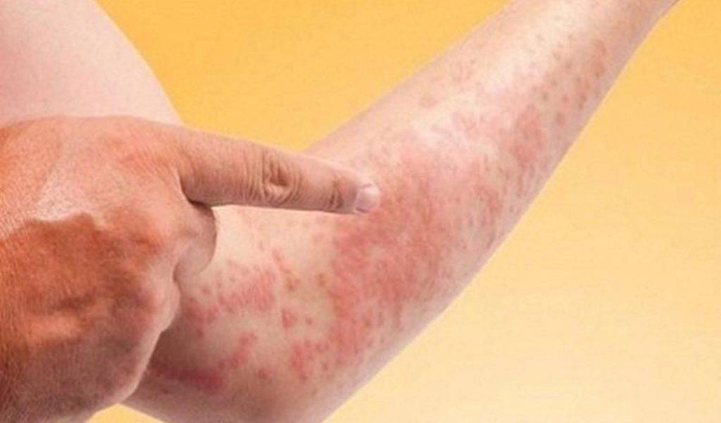 các bệnh ngoài da biểu hiện và cách phòng chống - Image 2