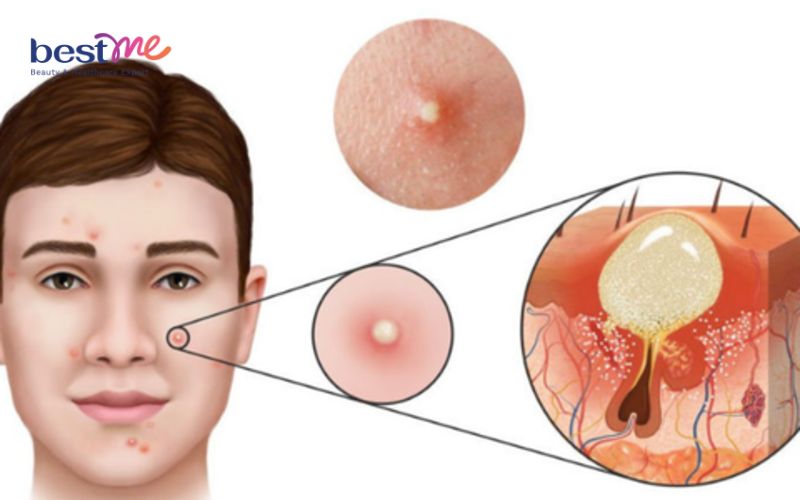 các bệnh về da mặt - Image 3