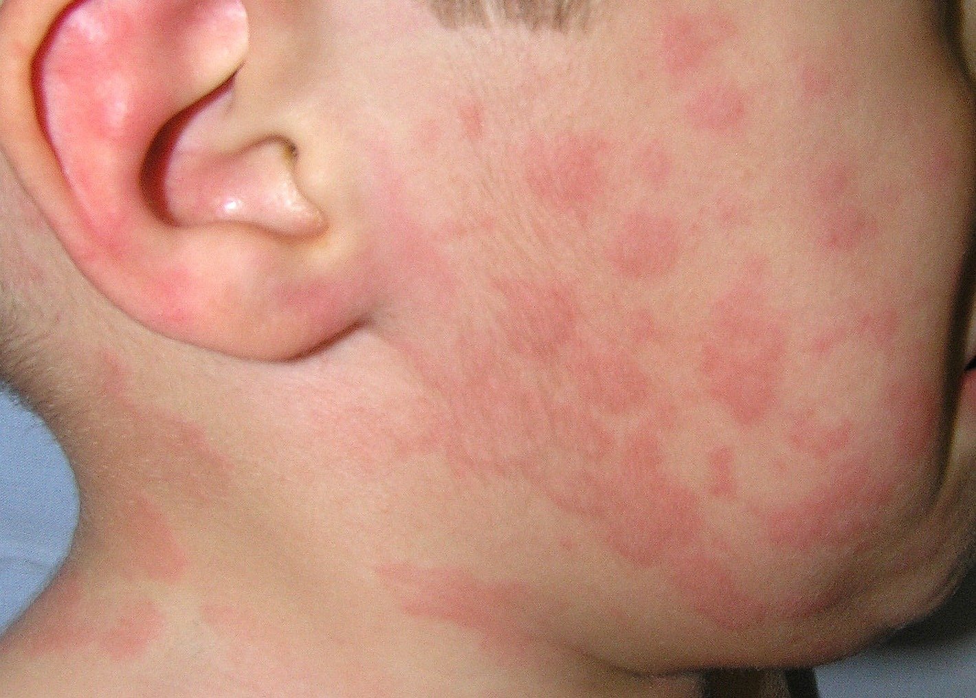 các bệnh về da mặt - Image 4