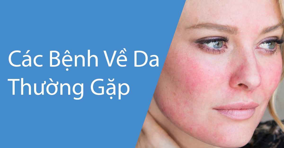 các bệnh về da mặt - Image 5