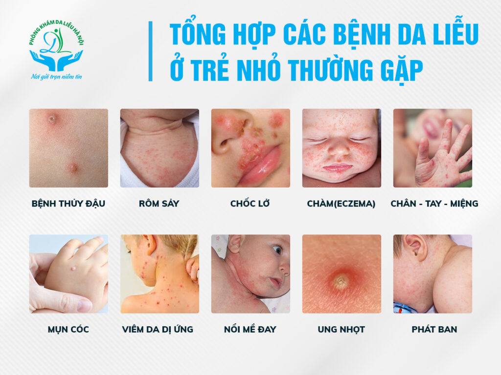 các bệnh về da thường gặp ở trẻ nhỏ