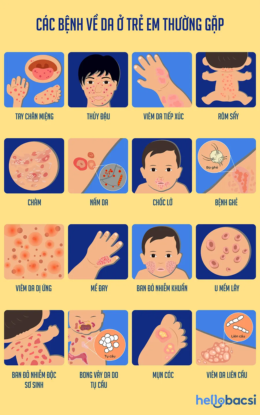 các bệnh về da thường gặp ở trẻ nhỏ - Image 2