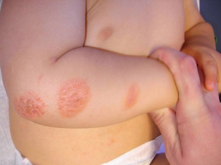 các bệnh về da thường gặp ở trẻ nhỏ - Image 3