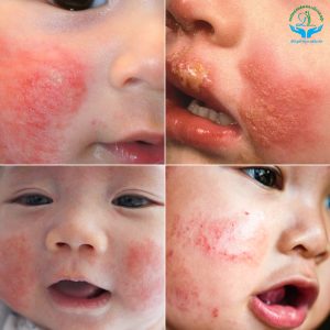 các bệnh về da thường gặp ở trẻ nhỏ - Image 4