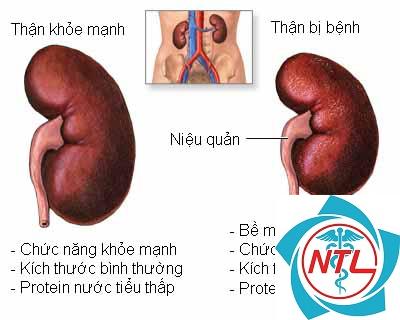 các bệnh về thận - Image 4