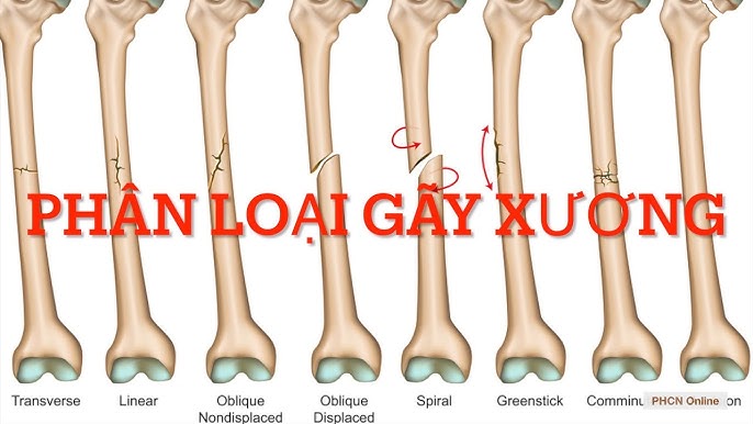 các kiểu gãy xương - Image 2