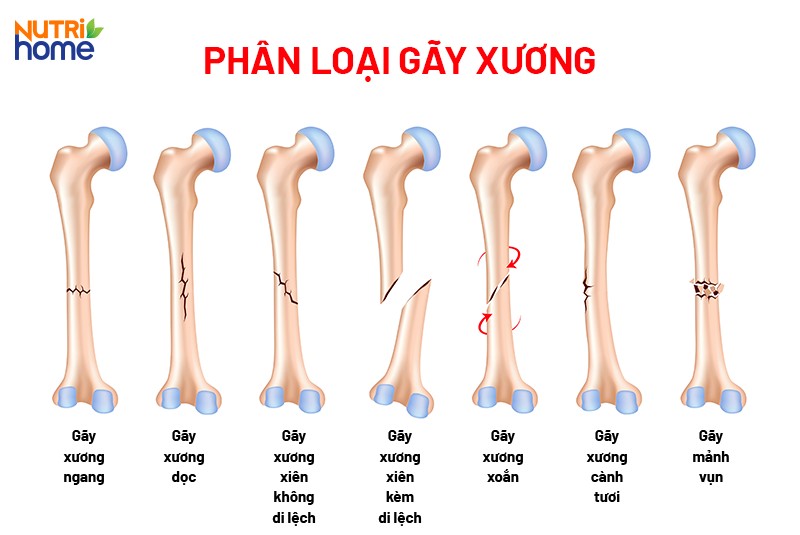 các loại di lệch trong gãy xương - Image 1