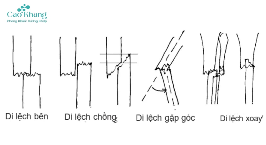các loại di lệch trong gãy xương - Image 2