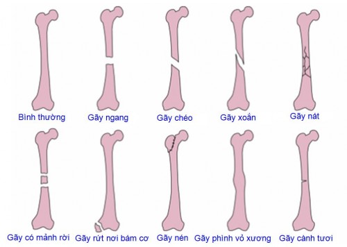 các loại di lệch trong gãy xương - Image 3