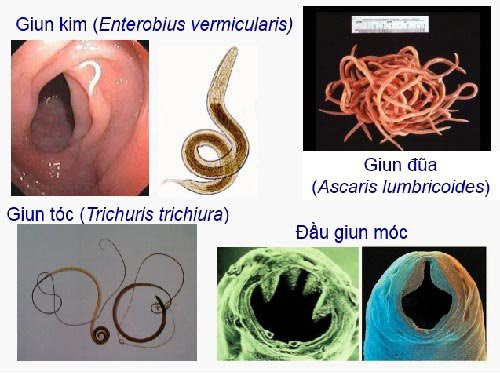 các loại giun ở trẻ em