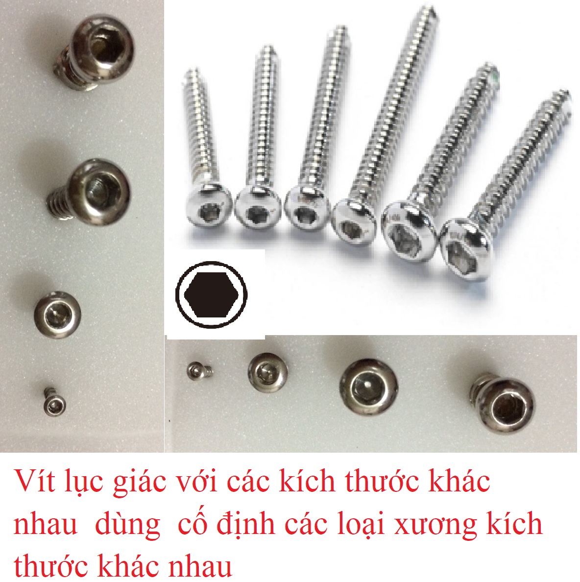 các loại nẹp vít xương - Image 4