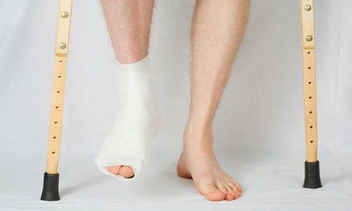 cách chăm sóc chân sau khi tháo bột