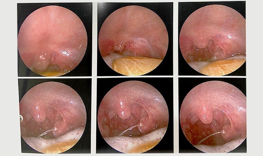 cách chữa bị hóc xương cá ở cổ - Image 3