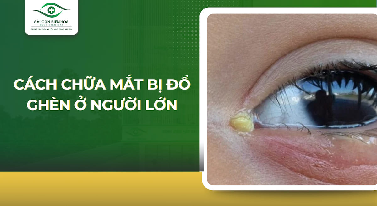 cách chữa mắt bị đổ ghèn - Image 3