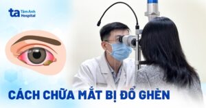 cách chữa mắt bị đổ ghèn