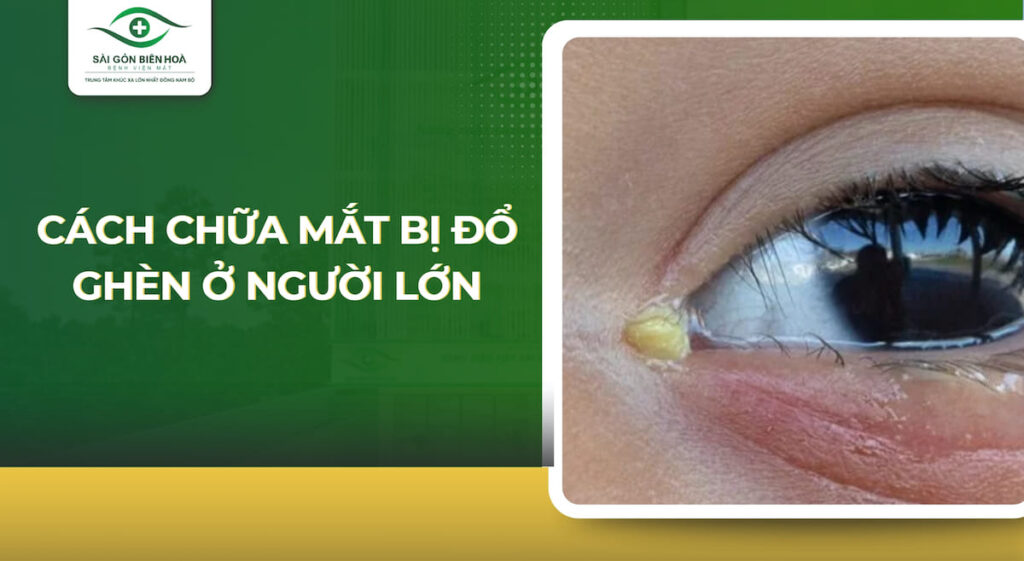 cách chữa mắt bị đổ ghèn ở người lớn