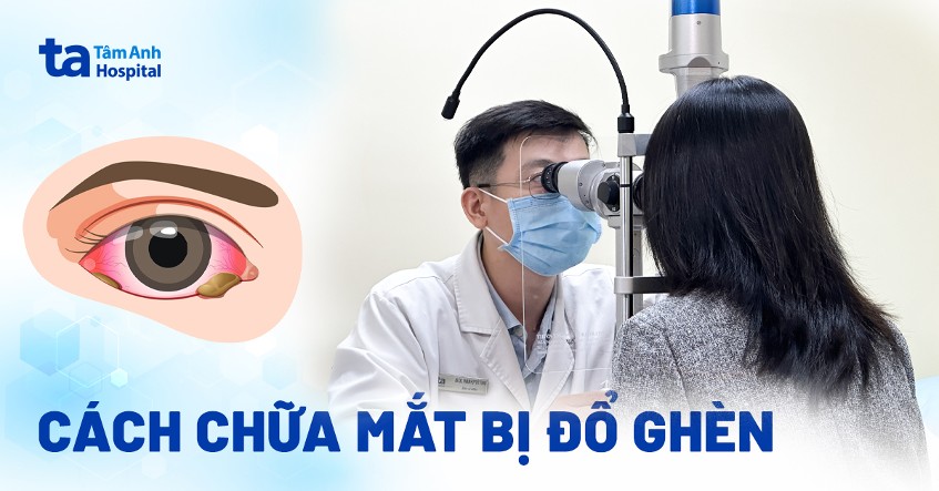 cách chữa mắt bị đổ ghèn ở người lớn - Image 3