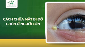 cách chữa mắt bị đổ ghèn ở người lớn