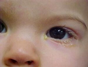 cách chữa viêm bờ mi mắt ở trẻ sơ sinh