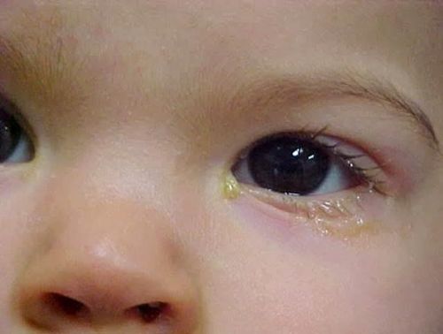 cách chữa viêm bờ mi mắt ở trẻ sơ sinh