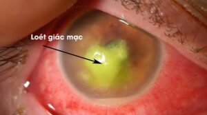 cách chữa viêm loét giác mạc