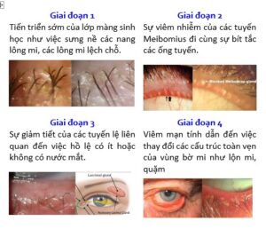 cách chữa viêm mí mắt trên