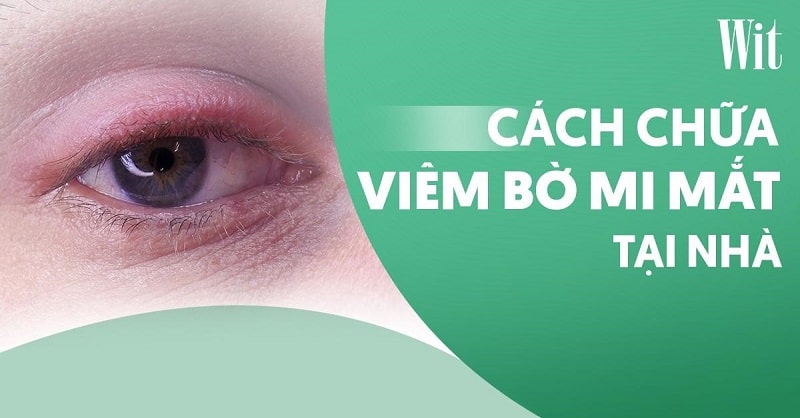 cách chữa viêm mí mắt trên - Image 5