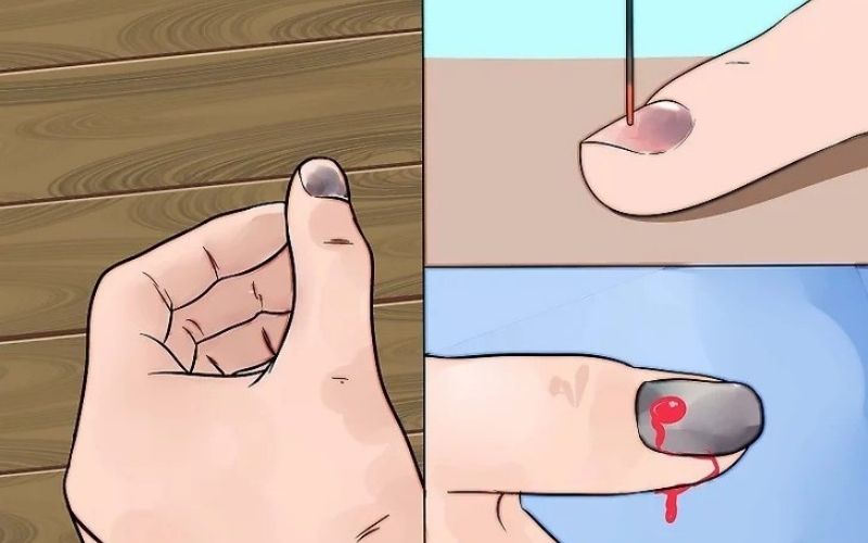 cách giảm đau khi bị dập tay - Image 2