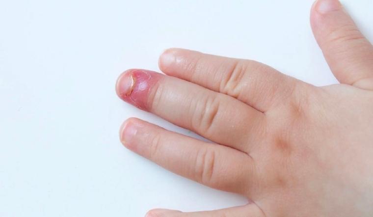 cách giảm đau khi bị dập tay - Image 4