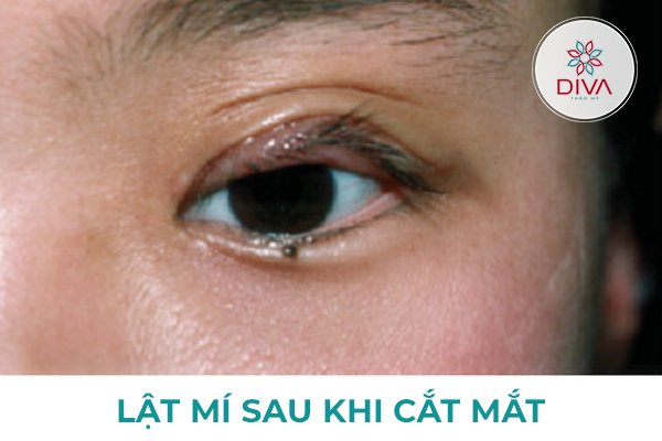 cách lật mí mắt - Image 5