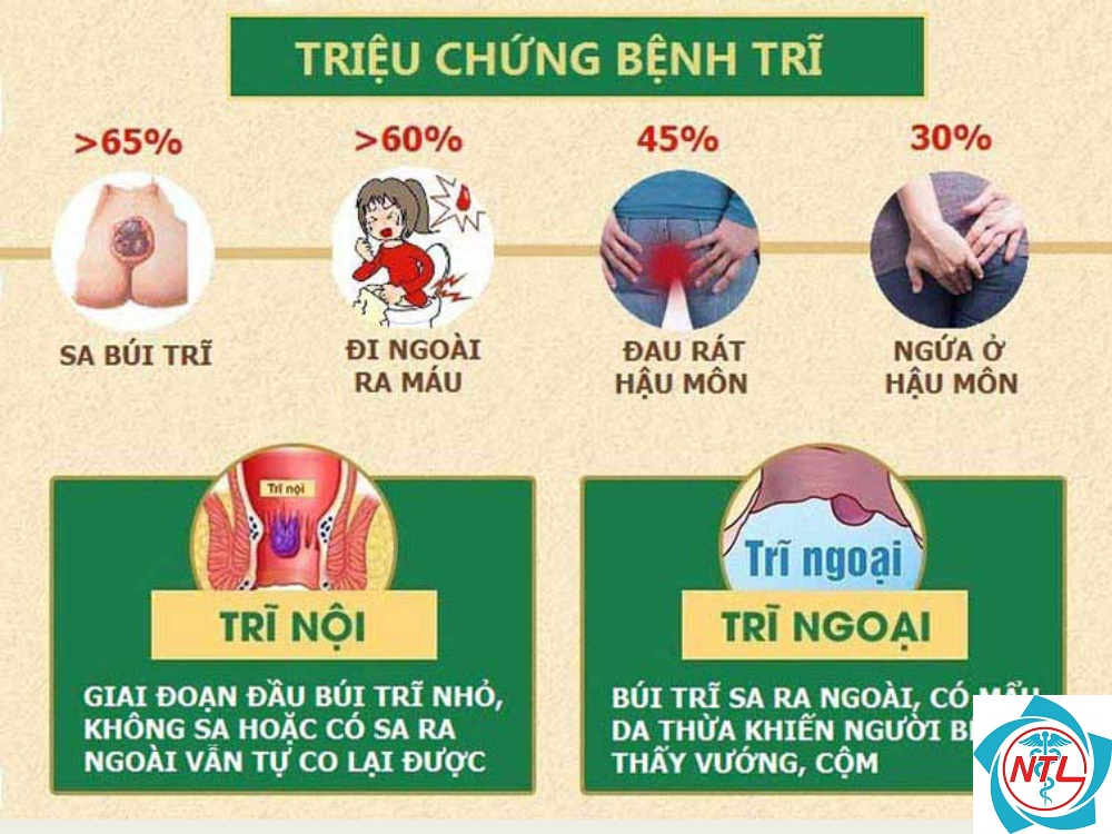 cách ngừa bệnh trĩ