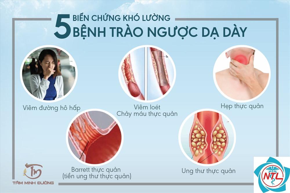 cách nhận biết bệnh trào ngược dạ dày thực quản - Image 3