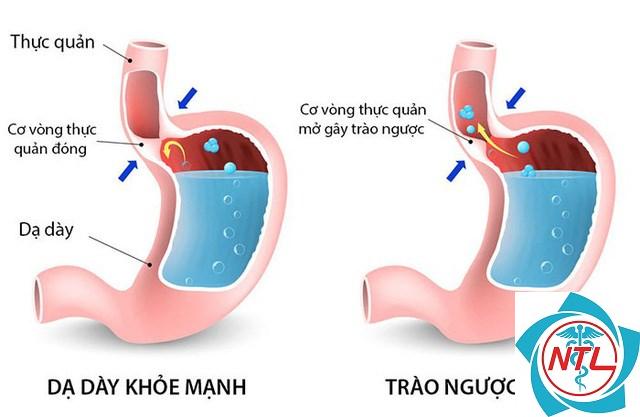 cách nhận biết bệnh trào ngược dạ dày thực quản