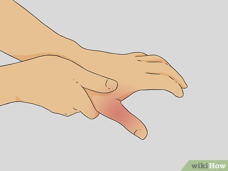 cách nhận biết gãy xương ngón tay - Image 4