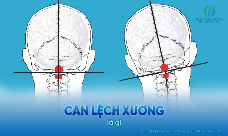can lệch xương là gì