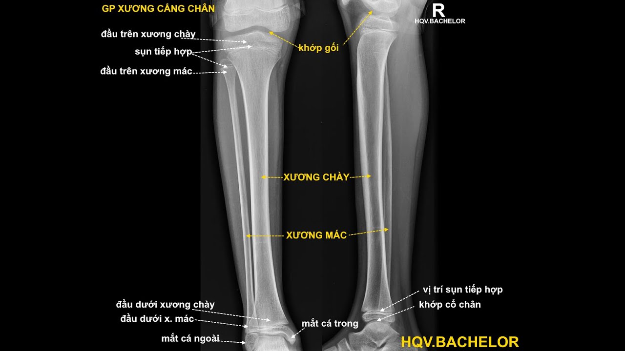 can xương trên xquang - Image 4